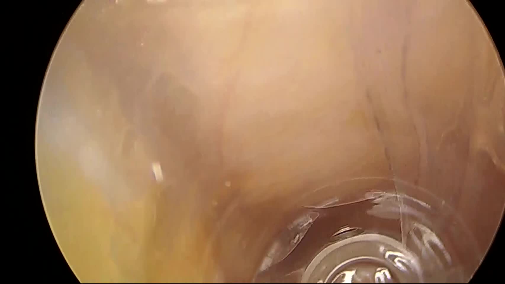 80-01-hd071　動画1　図4　右Endoscopic ACS