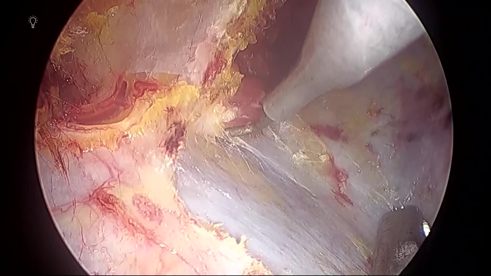 80-01-hd073　動画3　図11　eTEP-TAR Pretransversalis spac...