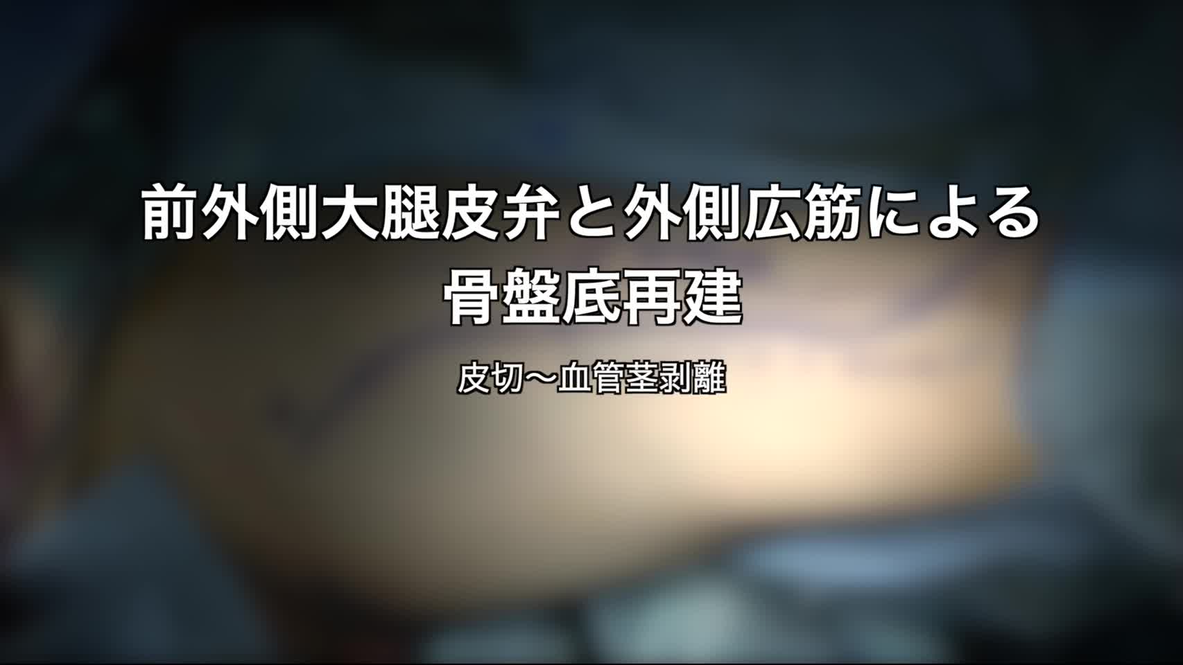 80-06-101赤澤論文　動画１　図2,3  臨床外科皮切〜血管剥離...