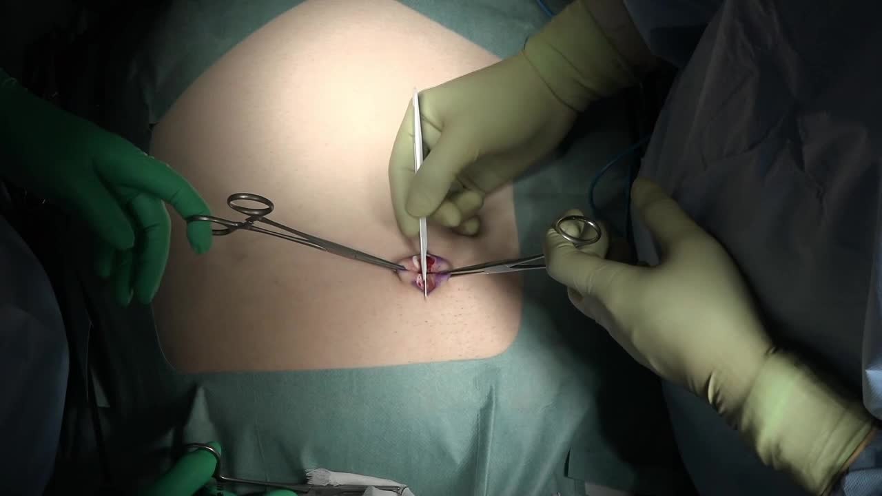 80-10-121浅井論文　動画1 Fundus-first technique...