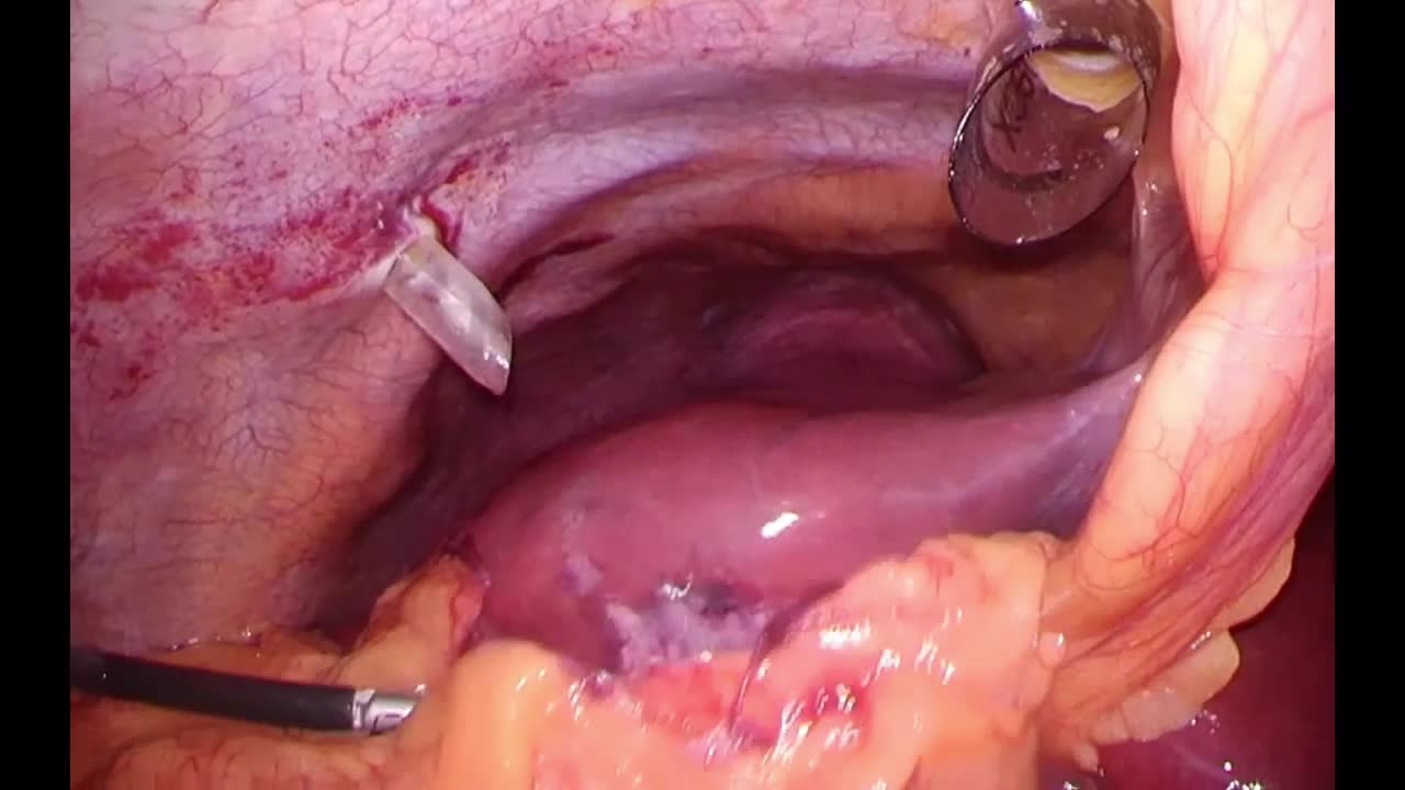 80-10-124浅井論文　動画4 エンドループ法...