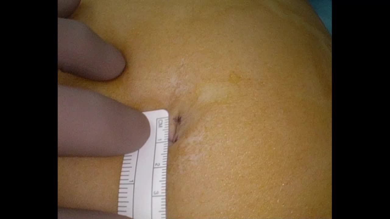 80-10-101亀山論文　動画１　皮膚切開からグローブ法...
