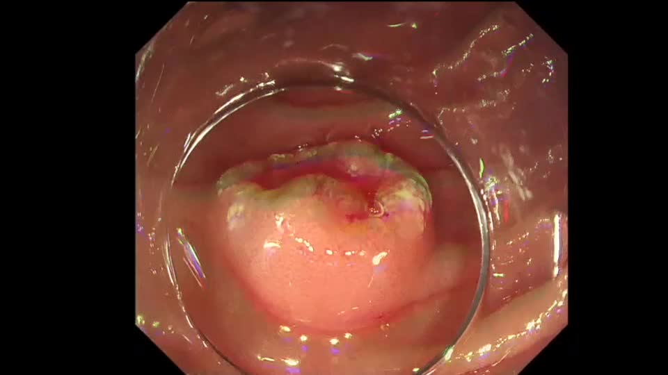 80-13-093　動画3　図3　D-LECS with ESD