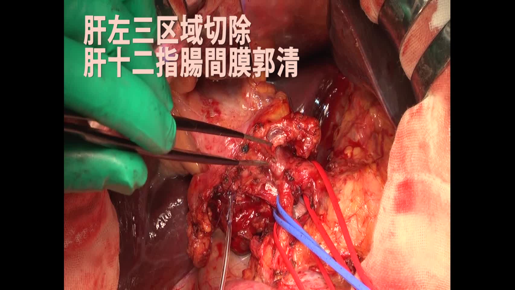81-02-101高橋論文　図２c,d　左三区域切除 肝門郭清...